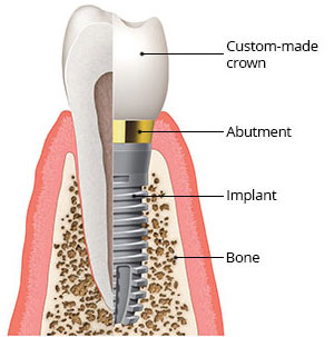 Implant Diagram